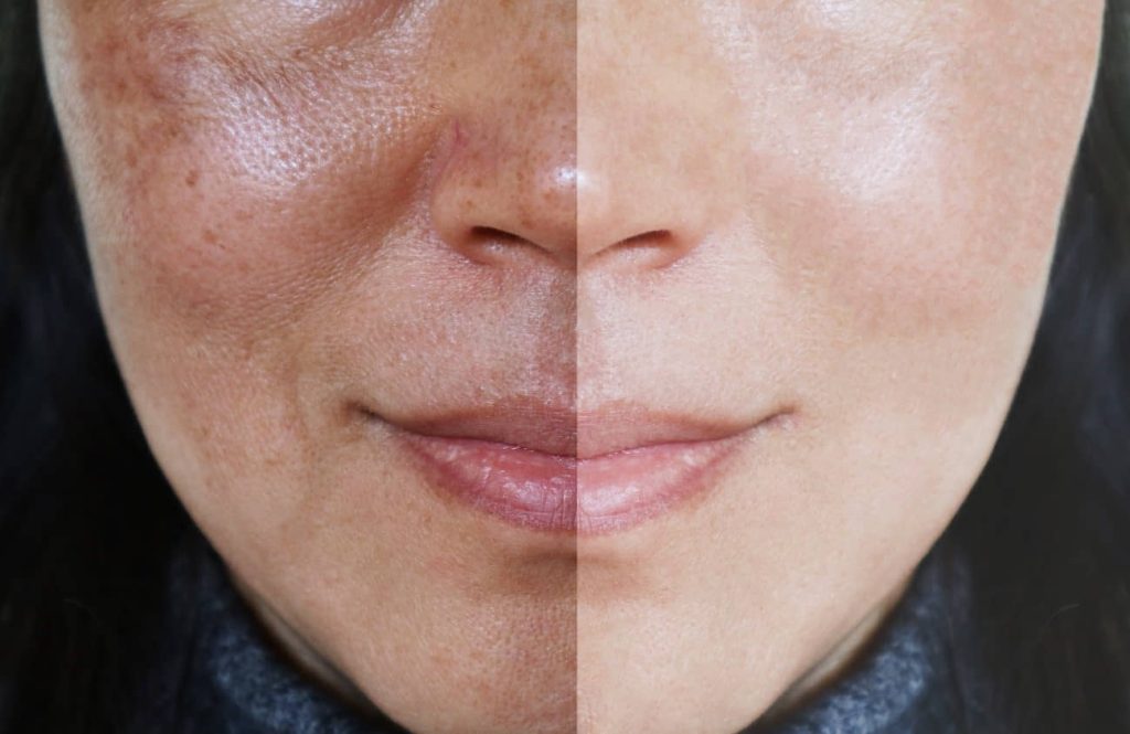 alteraciones de pigmentación en el rostro