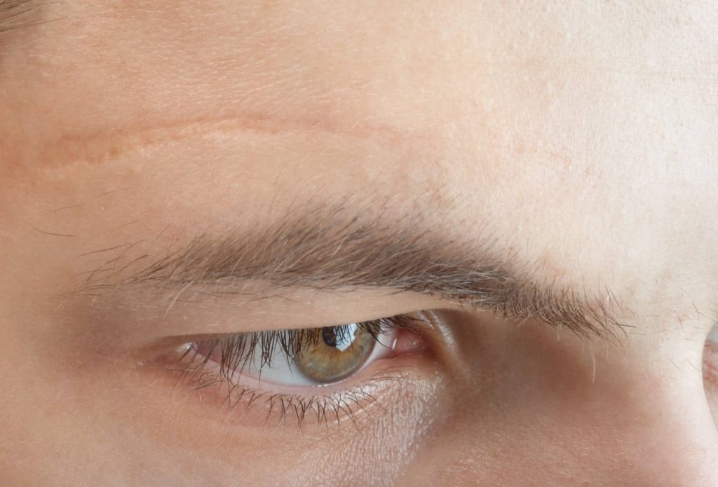 cicatrices en cejas
