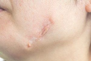 eliminación de cicatrices y queloides