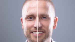 patas de gallo en hombres