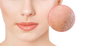 tratamiento para eliminar cicatrices en el rostro