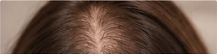 Tricología en Granada: estudio de la alopecia androgenética