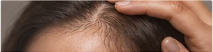 Tricología: evaluación de la alopecia areata