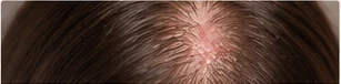 Valoración del cuero cabelludo y dermatitis seborreica
