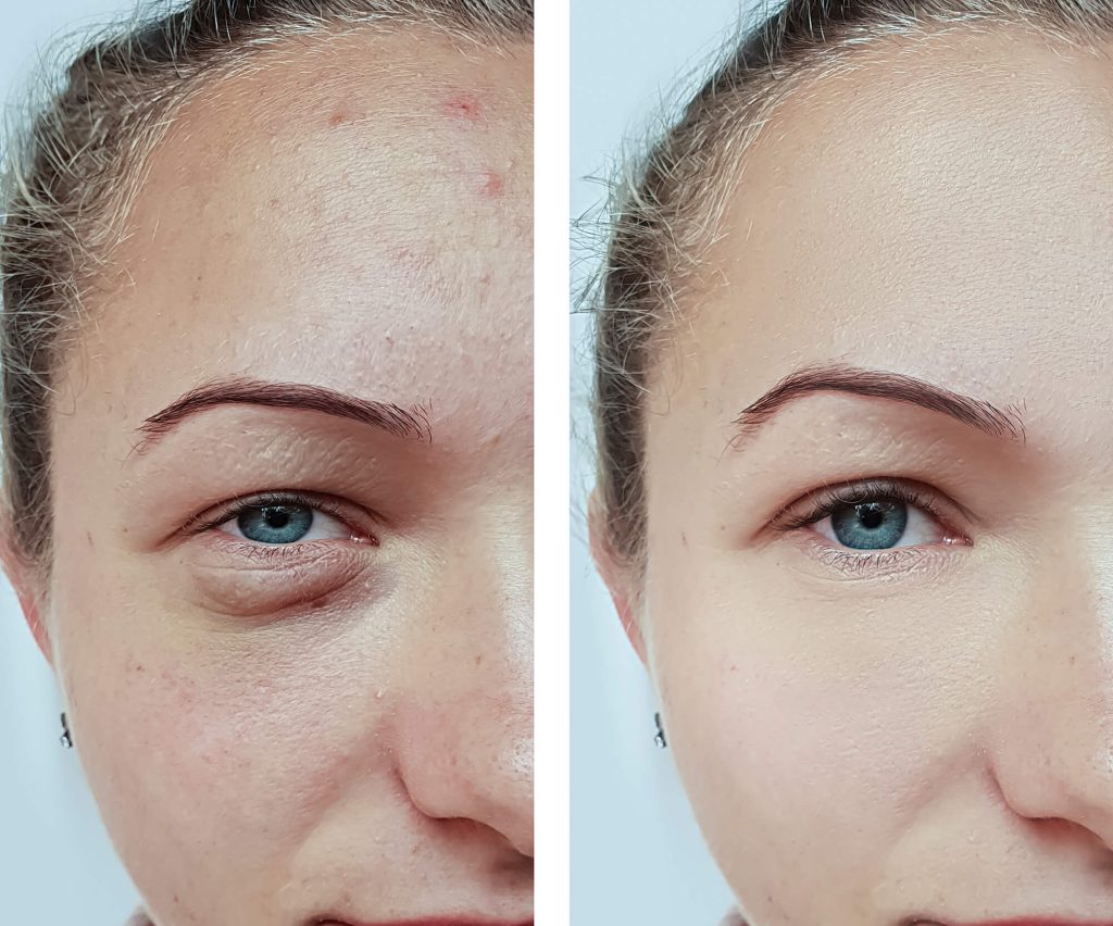 Tratamiento para marcas en el rostro