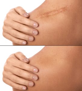 eliminación de cicatrices queloides