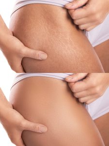 tratamientos para eliminar estrías cutáneas