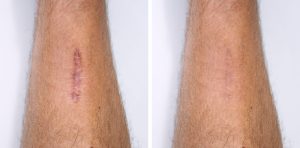 eliminación de cicatrices queloides en brazos
