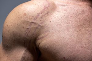 hombre con estrías cutáneas