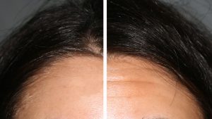 eliminación de arrugas de expresión