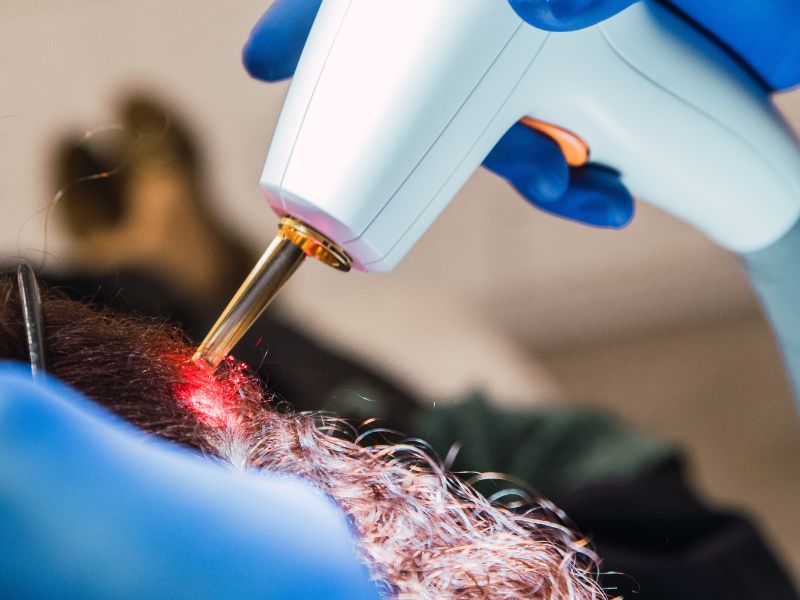 tratamientos para la caída del cabello