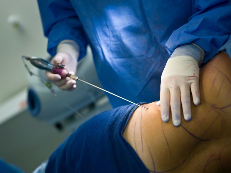 liposucción para reducir grasa localizada