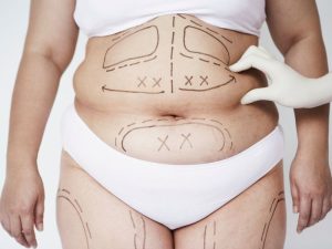 diferencias entre liposucción y métodos no invasivos para reducir grasa