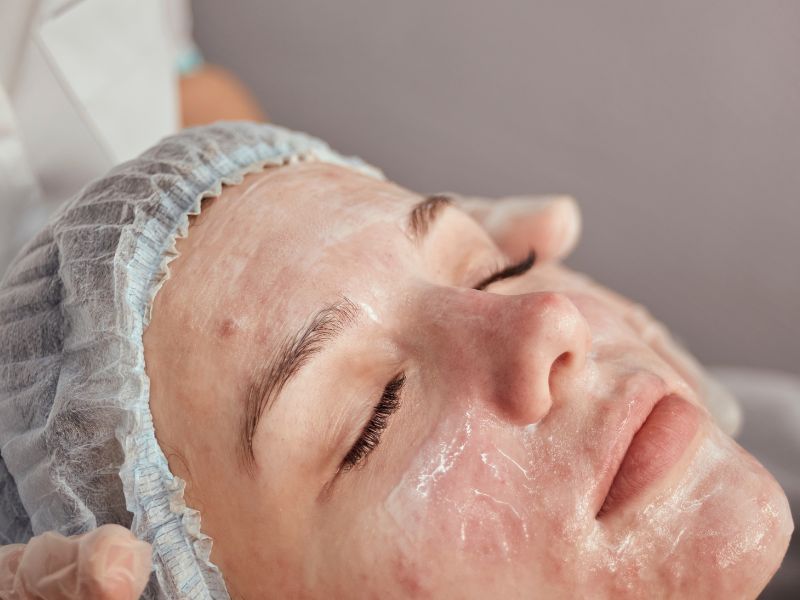 tratamiento para el acné