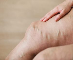 eliminación de varices