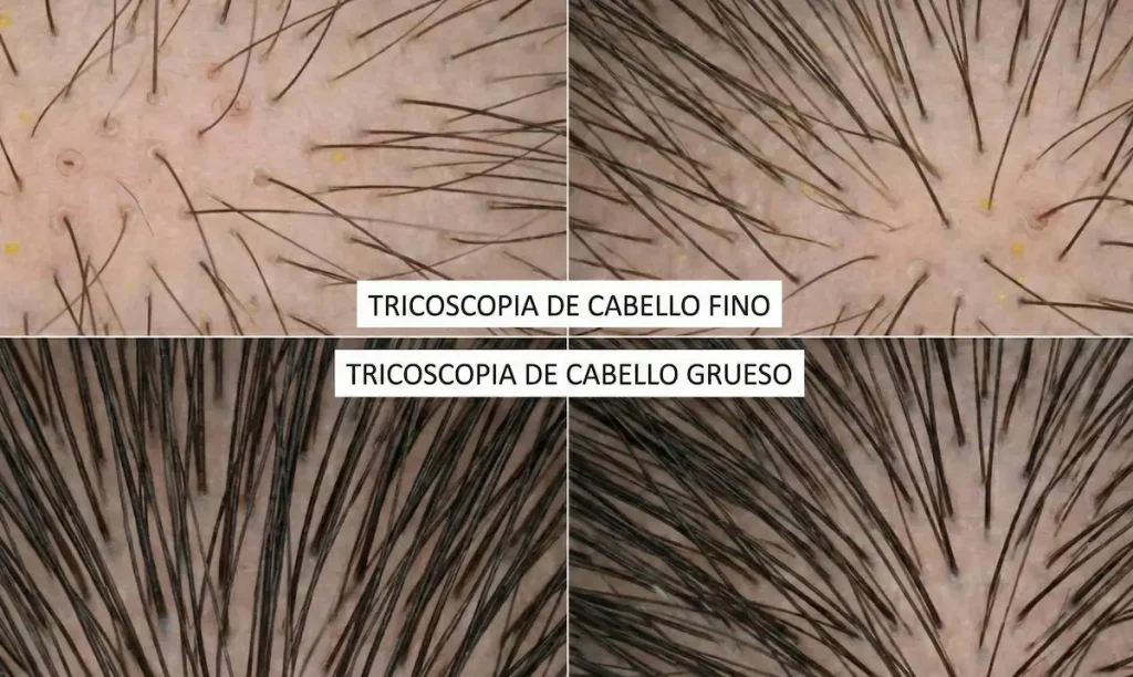 Diagnóstico capilar mediante tricoscopia en cuero cabelludo