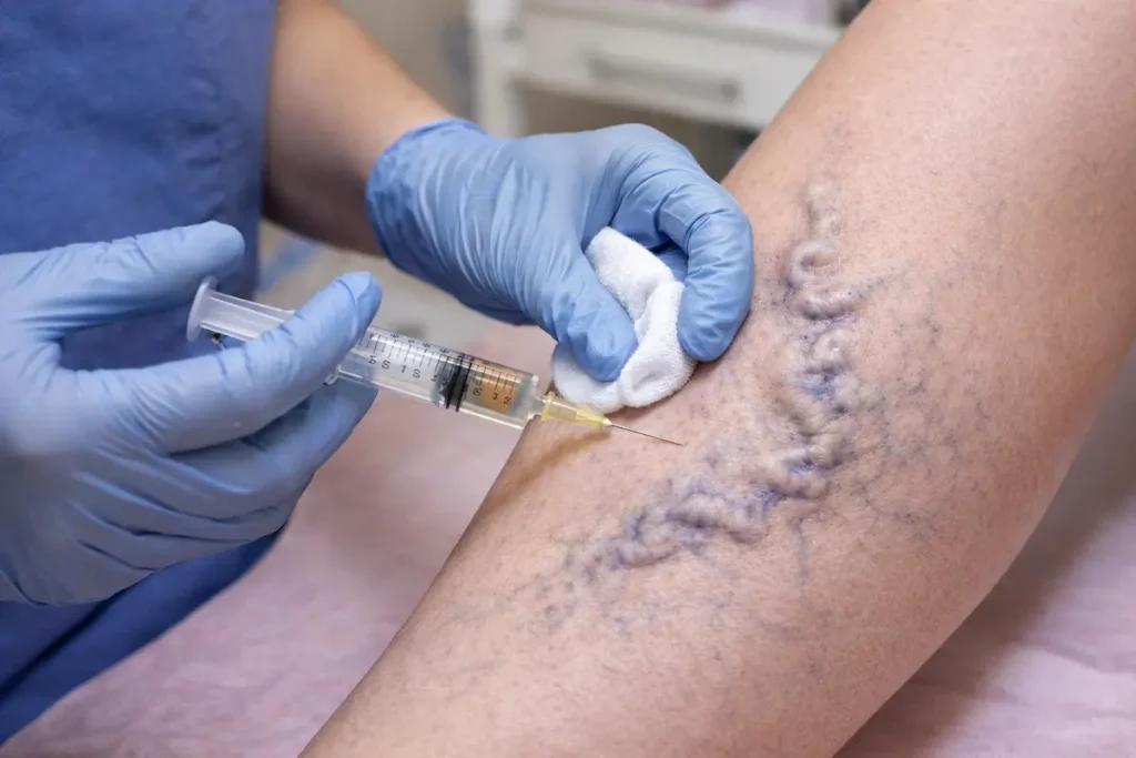 Varices en piernas con necesidad de valoración médica especializada