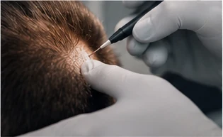 Evaluación capilar previa a un trasplante de cabello