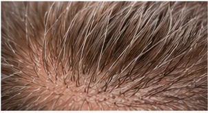 Detalle del cabello para valorar un trasplante capilar